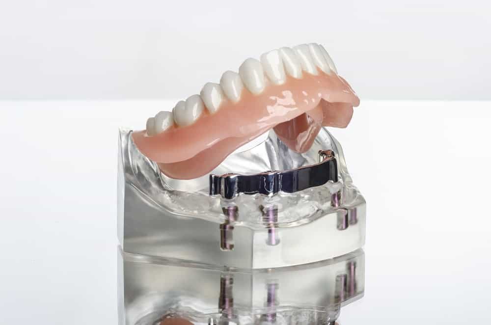 Für wen sind Implantate geeignet - Feste Zähne an einem Tag Bremen